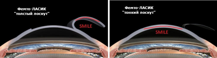 Коррекция после смайл. Коррекция зрения Фемто ласик. Лазерная операция на глаза Фемто ласик. Фенто ласте. Ласик (LASIK)/Фемто ласик (Femto LASIK).