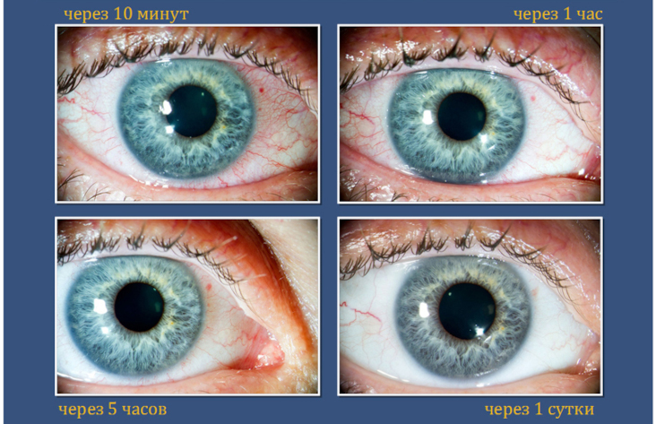 Внешний вид глаза после операции СМАЙЛ