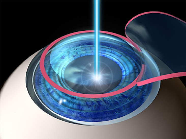 Восстановление зрения лазером по методике ЛАСИК