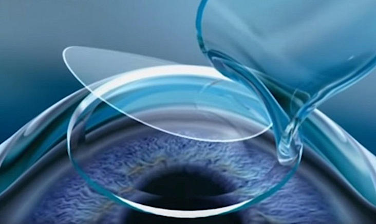 Лазерное восстановление зрения Flex