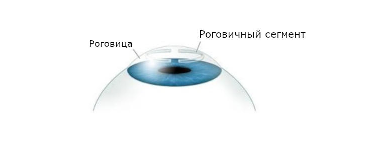 Роговичные сегменты для улучшения остроты зрения после лазерной коррекции