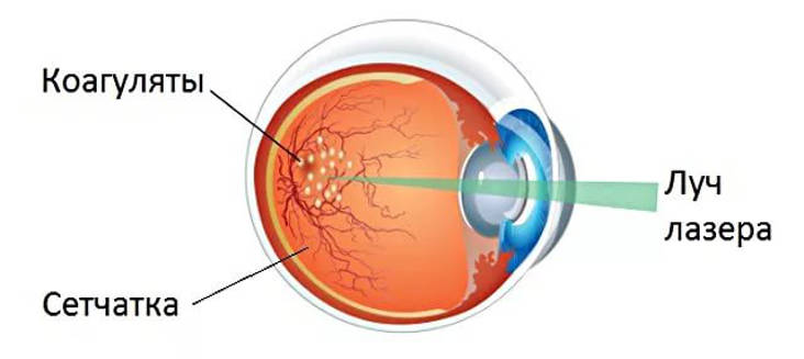 Лазерная коагуляция сетчатки глаза перед лазерной коррекцией зрения