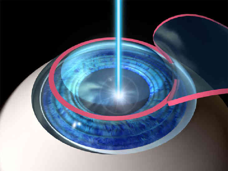 Лазерная коррекция зрения ЛАСИК (LASIK)
