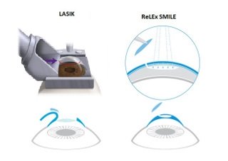Сравнение LASIK и SMILE какой метод лазерной коррекции зрения лучше