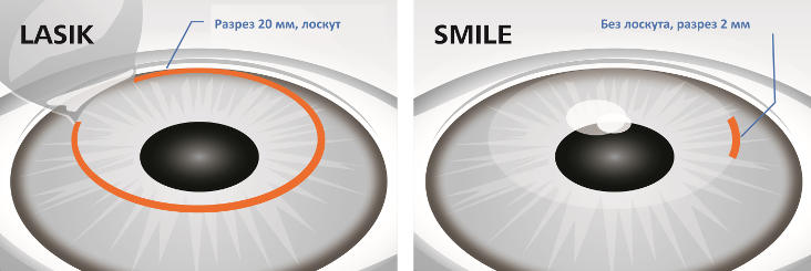 Лазерная коррекция зрения по ОМС в клинике Кузляр в Казани - лечение глаз по ОМС