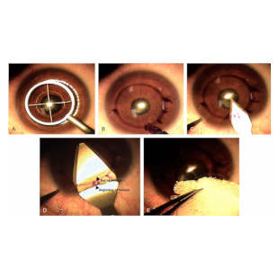 Лазерная коррекция зрения ReLEx SMILE (CМАЙЛ) после кератотомии