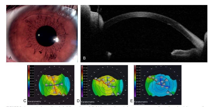 Лазерная коррекция зрения после насечек на роговице (радиальной кератотомии)