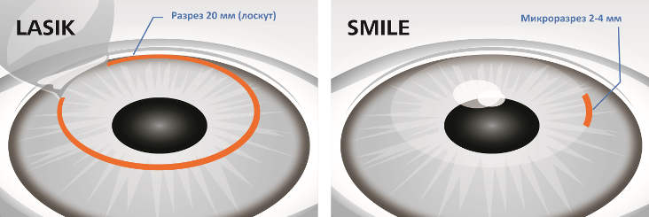 Операции ЛАСИК (LASIK) и СМАЙЛ (ReLEx SMILE) - что лучше
