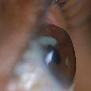 Ятрогенная кератэктазия после лазерной коррекции зрения