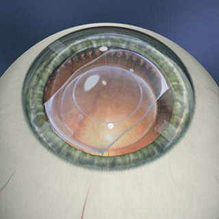 Имплантируемые контактные линзы