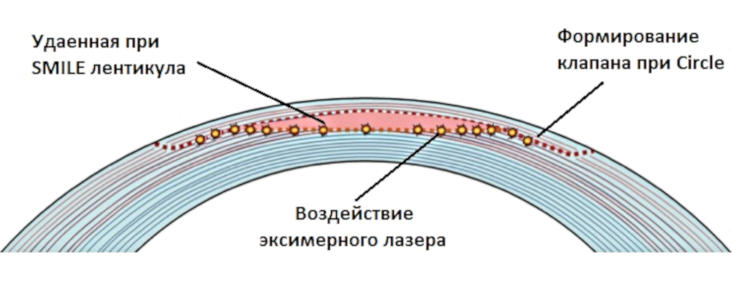 Витреолизис – лечение деструкции стекловидного тела