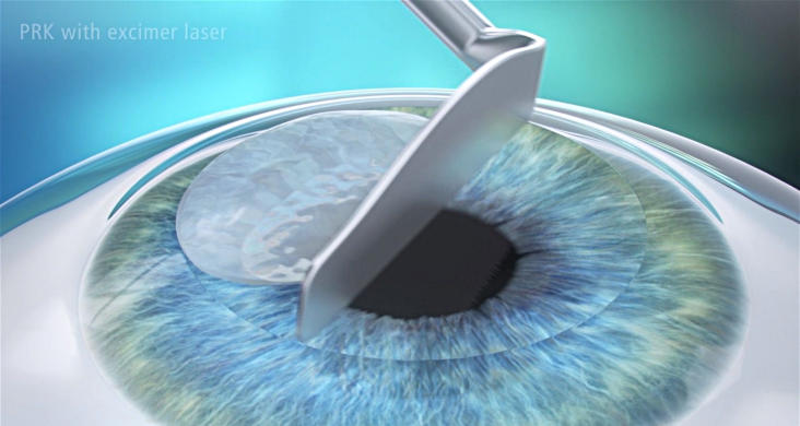 Механическое удаление эпителия при коррекции зрения ФРК
