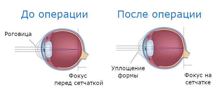 Изменение формы роговицы и фокуса до и после лазерной коррекции зрения при миопии