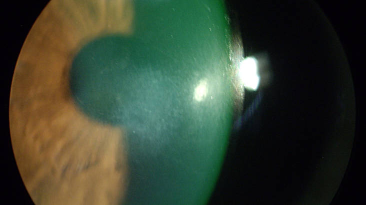 Хейз (помутнение роговицы) после лазерной коррекции зрения ФРК